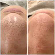 予約殺到★【詰まり・ざらつき撃退】毛穴洗浄（全顔）¥6,600→¥5,500