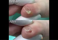 [新規限定]【副爪１箇所(小指にあるモノ)】+【爪切りセット】¥7,150→¥5,500