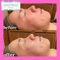 【クリスティーナ💚アンストレス】😇SNS話題『乳酸菌ピーリング』ニキビ・敏感肌・毛穴¥24,200⇒¥12,000