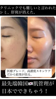 スーパージェクション1%韓国🇰🇷最先端美容