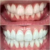 【歯の黄ばみに】ホワイトニング20分コース☆歯の色が本当に白くなる