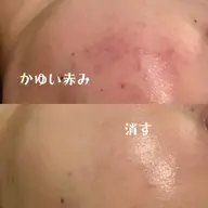 【13日限定❤️❕】ニキビ/ニキビ跡/毛穴/乾燥などが気になる方⭐️3300円‼️