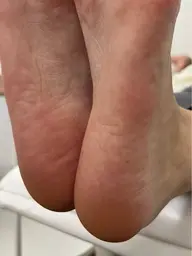 かかと角質ケア👣　　ガサガサかかとからふわふわかかとへ☆足裏のかかとメインのマシンでの角質ケア。