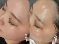 周年祭⭐︎１度で艶肌へ【ララピール&鎮静パック】