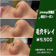 【ミニモ限定】鼻/顎/眉間の角栓,黒ずみ除去【溶ける角栓毛穴吸引&洗浄】¥5,980→¥4,980