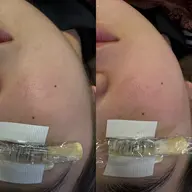 ⭐︎人気No.1⭐︎《眉毛＆まつ毛＆お顔脱毛》　　　　　　　　　　　　　スペシャルセット