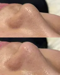 【先着10名】つるん♡毛穴スッキリmenu🫧