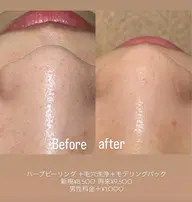 【肌質改善🌿人気NO1】毛穴洗浄×ハーブピーリング 60分¥9200⇨¥6300［毛穴、ニキビ悩みはこれで完璧‼️］