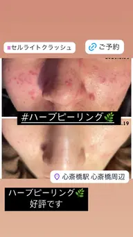 🌿国産ハーブピーリング🌿　1部位選んで！！