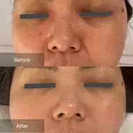 「敏感肌・赤み・炎症でお悩みはこれ!」【SEN管理】