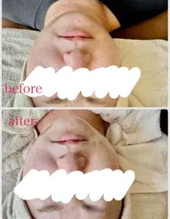 モニター募集！！筋膜リリースでリフトアップ、小顔に！！ほうれい線にも！！