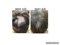 初回限定✨強髪プログラム（ヒト肝細胞培養液）を使用した頭皮ケア