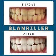 まずはお試し🎶大人気✨15分×2回セルフホワイトニング 3000円❤️ご新規様という利用条件のみ‼口コミ投稿等は不要✨