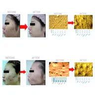 ◆ご新規様限定◆人気No.1【ニキビ全6種類対応アクネケア】パーソナライズケア