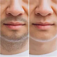 《期間3名様限定》【メンズ】全身脱毛★（VIO除く）