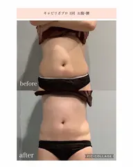 【半身スリム】上or下半身 (キャビテーション/ラジオ波/吸引/EMS) 結果重視最強マシン