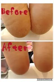 フット角質ケア