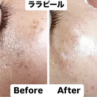 【艶肌リフトUP💎】ララピール《顔＋首》＋デコルテリンパ＋プレミアムゲルLDM導入＋ヒト幹細胞パック