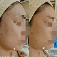 【できた跡&肌の凹み】なめらかつや肌に！ニキビ跡ケア フェイシャル