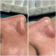 【お肌の悩み一つで解決❣️】光フェイシャル✨