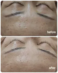 美白×収れんエステ