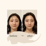 ✨人気no.1✨　　　　　　　　　　　　　　　　　　　美容鍼&整体のトータルケアコース