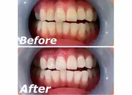 1ヶ月集中ケア🦷✨セルフホワイトニング