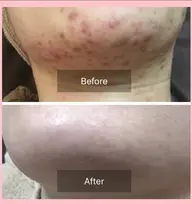 平日限定‼️フェイシャルハーブピーリングハード(剥離あり)🌿吹き出物、吹き出物の跡、毛穴、美白、黒ずみ、肌質ケアに🩷