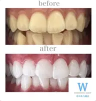 【1番人気☆フリーパスコース】20分×20回照射📣🦷