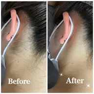 ✨🦋うなじ+背中+顔脱毛🦋✨