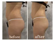 【男女】新生活に変化を【筋膜リリース全身痩身90分】¥18000→¥11000