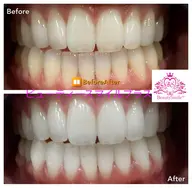 セルフホワイトニング 8分×2セット ¥4,400→¥3,300