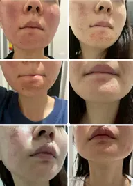 剥離ありハーブピーリング1g