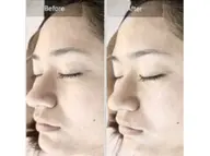 フェイシャルWAX脱毛