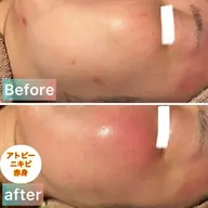 『アトピー』『ニキビ』肌再生フェイシャル120分