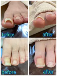 巻き爪補正　一箇所　（軽度）