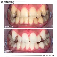 【初回限定】医療機関提携ジェルホワイトニング