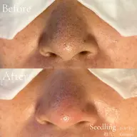 毛穴エクストラクション鼻のみ👃🏻【写真OKな方】
