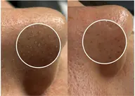 ザラつきくすみケア