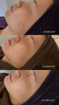 【繰り返すニキビに】肌質ケア3回集中コース🌟/フェイシャルエステ/クリスティーナ/ハーブピーリング