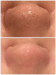 【3月末日まで】【毛穴開き/黒ずみ/いちご鼻】アクアピール+毛穴洗浄×高保湿ポレーション導入