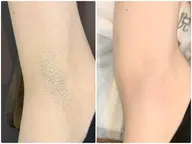 【期間限定】毛穴/ムダ毛改善　ワキ脱毛６回セット2900円　　男女受付可能　ジュニア脱毛OK