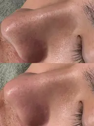 フルフェイス毛穴洗浄×贅沢パック付⭕️