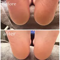 フット角質ケア👣