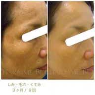 【シミ、シワ、たるみ、ニキビ、毛穴】あらゆる悩みを改善する肌質改善プログラム🌿最短3ヶ月​〜​お肌のパーソナルジム