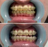 迷ったらこれ‼️【20​〜​30代向け】ホワイトニング&ハンドマッサージ付き