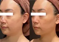 【コラーゲン糸リフト6本】¥19800→¥9800✨