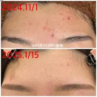 [本格肌改善トリートメント]ニキビケア/凸凹/毛穴ケア/HAAB REPRO ハーブリプロ体験￥22000→￥11000