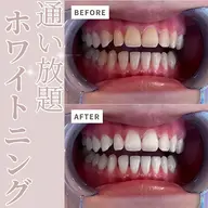 【🌸3月限定🌸】《セルフホワイトニング》韓国美白ホワイトニング[札幌/平岸/駅近]