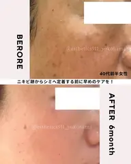 【お昼限定】肌荒れシミくすみ対策！水素高周波のWアプローチ！フェイシャルエステコース初回